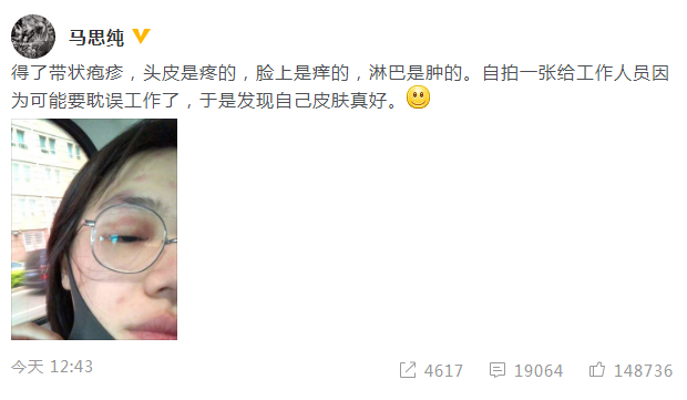 马思纯患带状疱疹